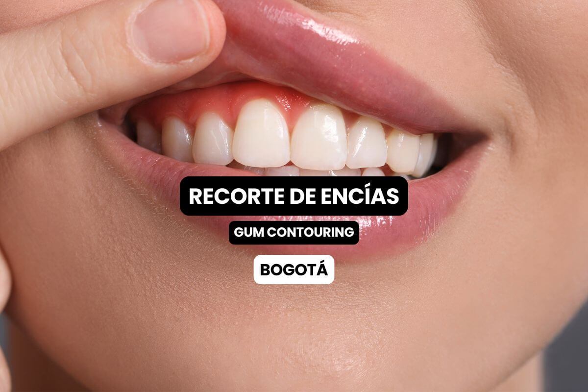 Recorte de Encías en Bogotá: Mejore la Forma de su Sonrisa de Manera Natural