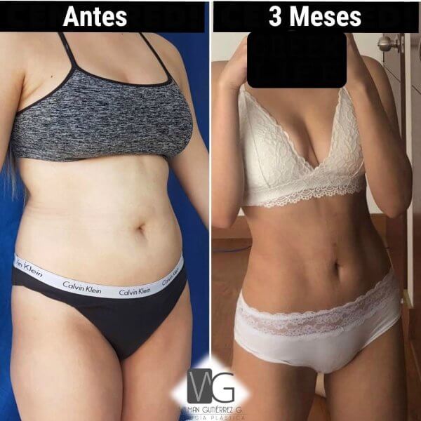 Lipoescultura
