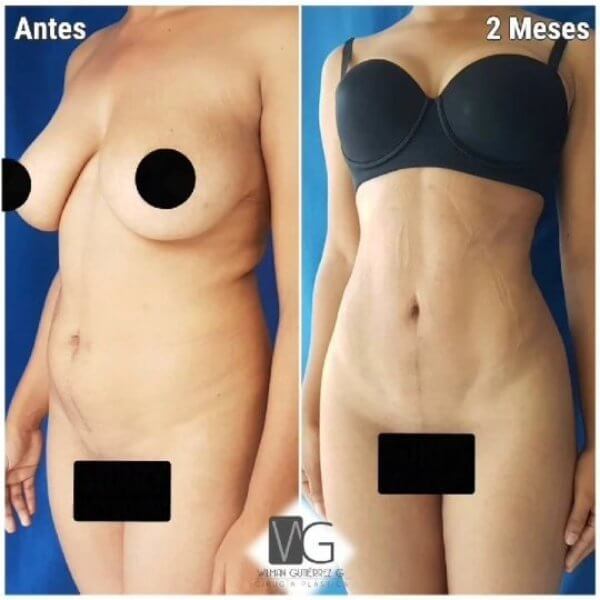 Lipoescultura