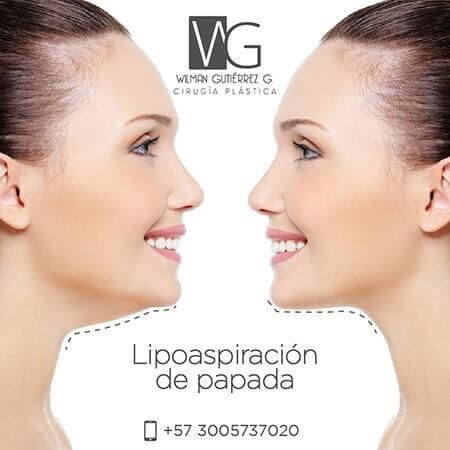 Chin liposuction