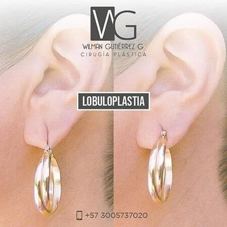 Lobuloplastia 