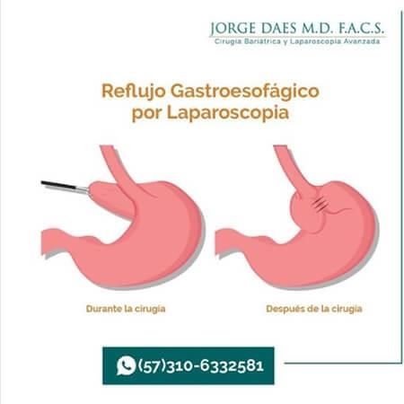 Cirugía Reflujo Gastroesofágico