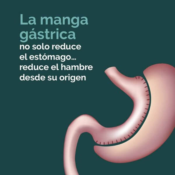 Manga gástrica