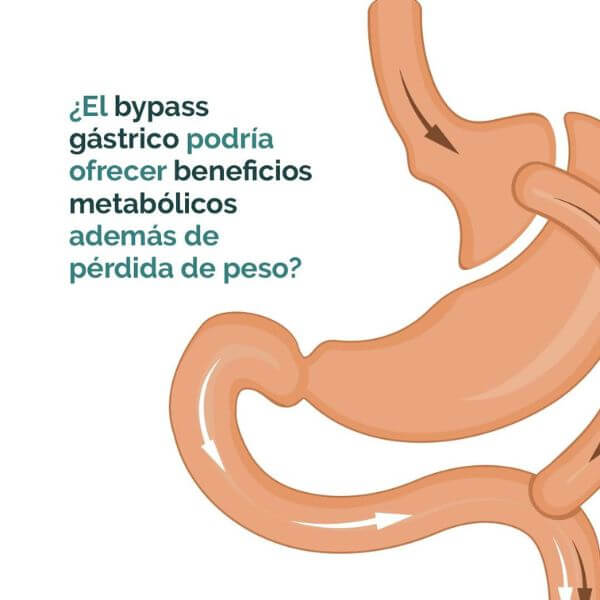 Gastric bypass