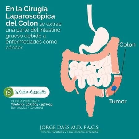 Laparoscopic Colon Surgery