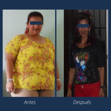 Cirugía bariátrica