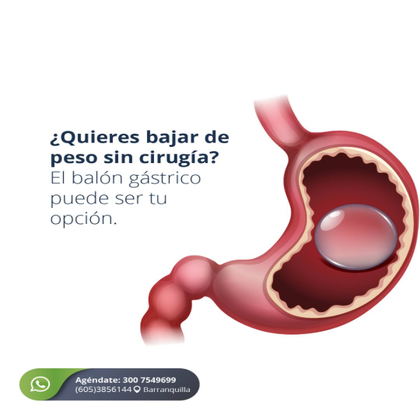 Gastric balloon