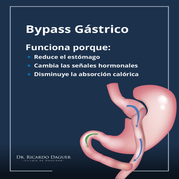 Bypass gástrico