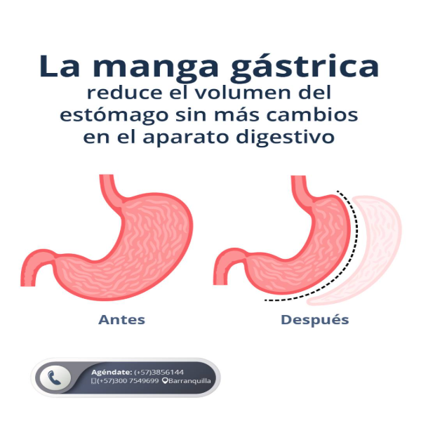 Gastric sleeve