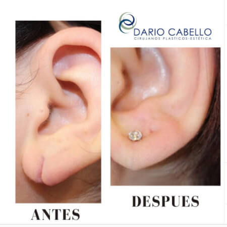 Lobuloplastia