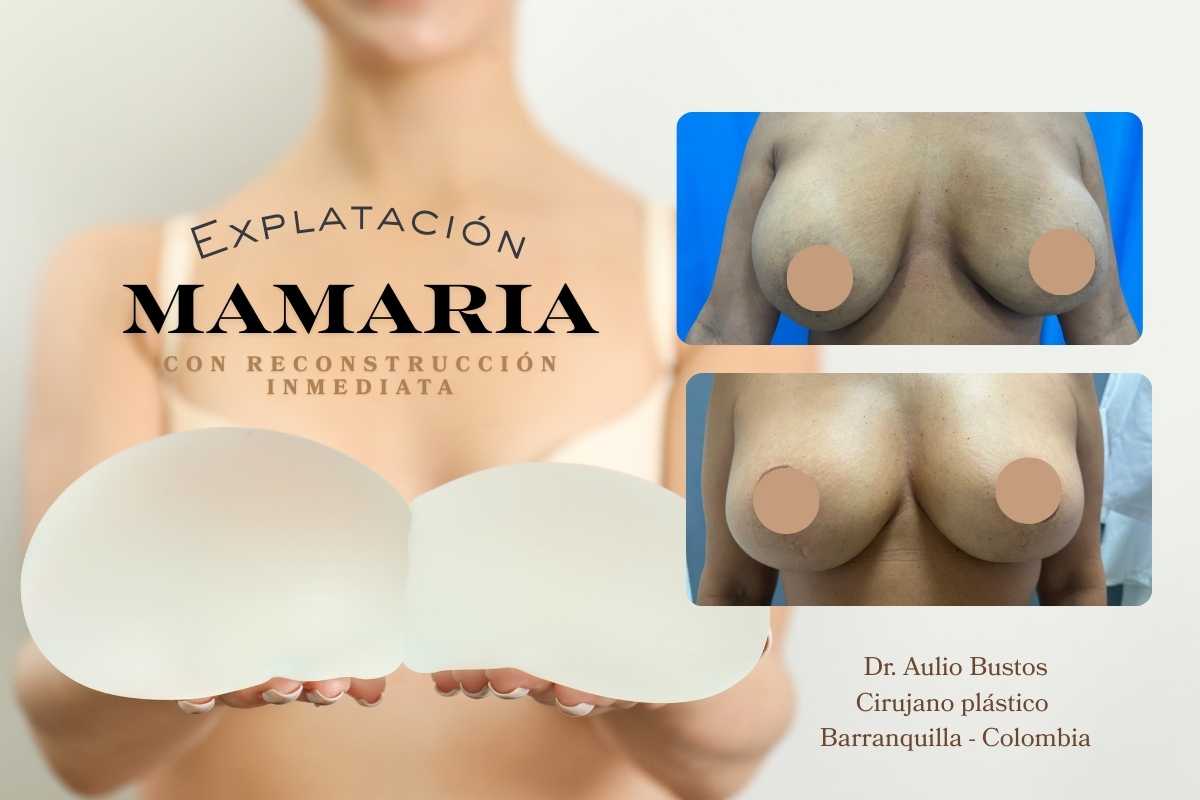 Breast Implant Removal Surgery in Barranquilla – Dr. Aulio Bustos, Plastic Surgeon