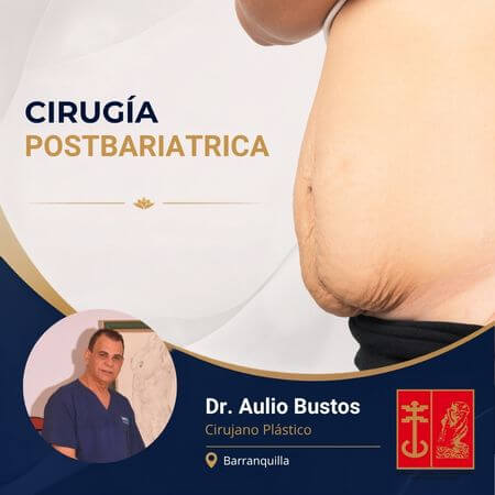Cirugía postbariátrica