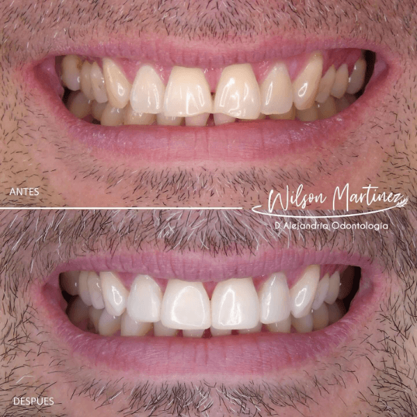 Smile design