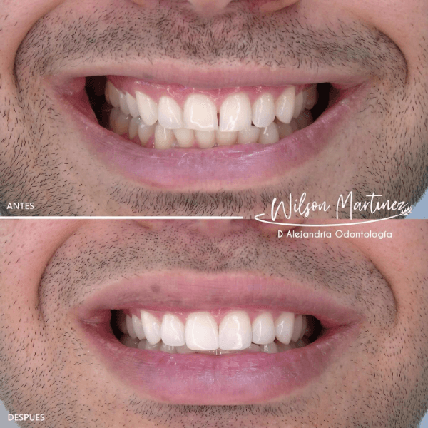 Smile design
