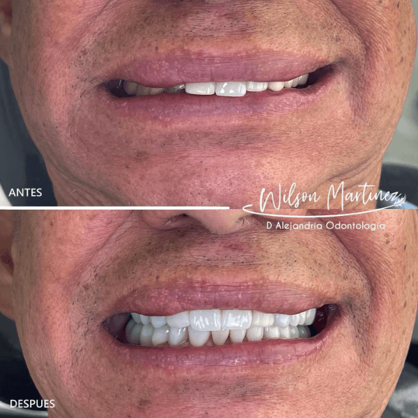 Oral rehabilitation