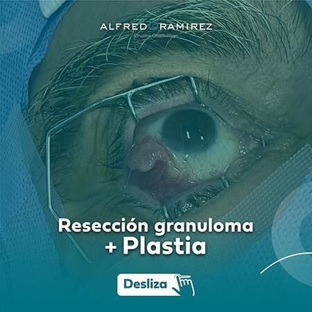 Granuloma