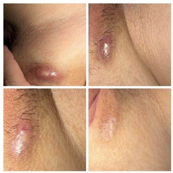Hidradenitis supurativa