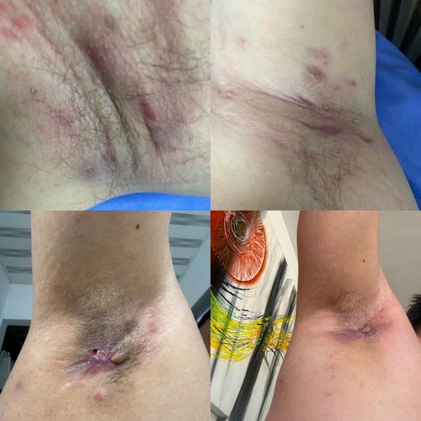 Hidradenitis supurativa