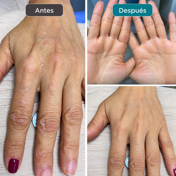 Dermatitis