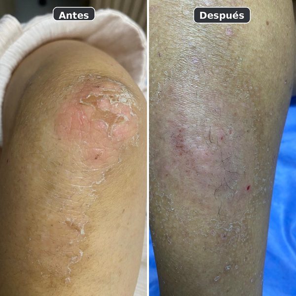 Dermatitis