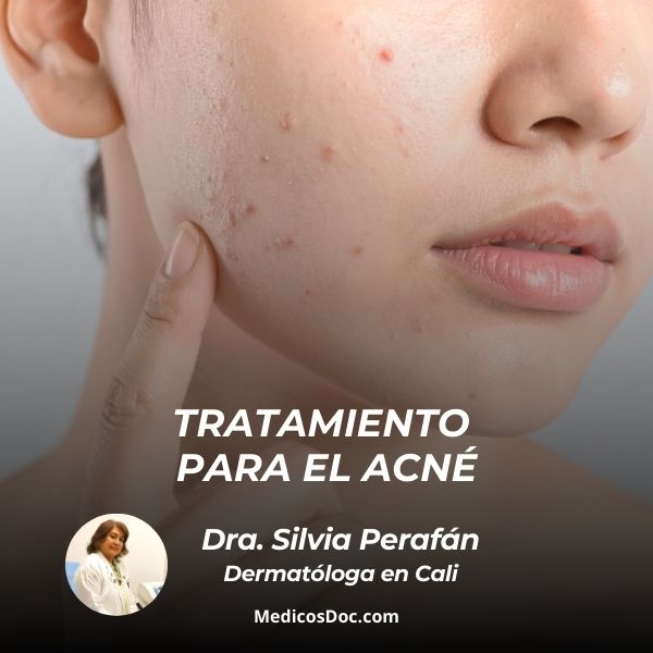 Tratamiento para el acné