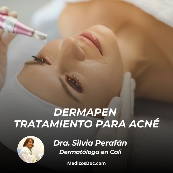 Dermapen tratamiento para acné