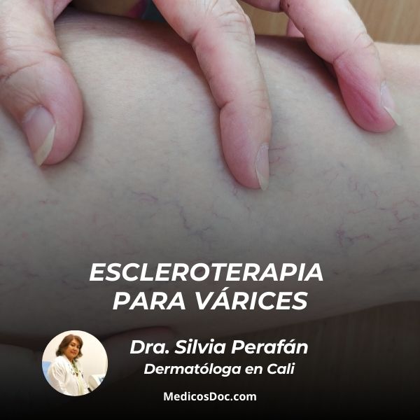 Escleroterapia para várices 