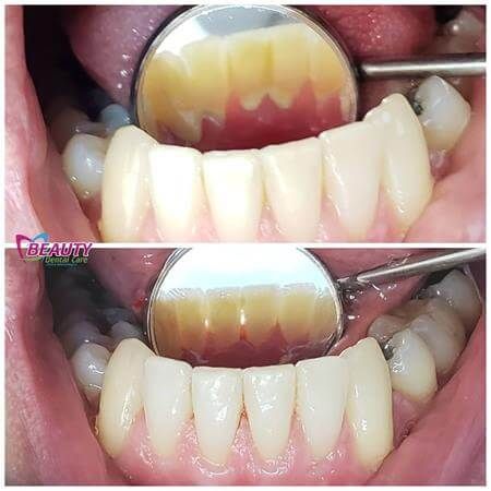 Limpieza dental