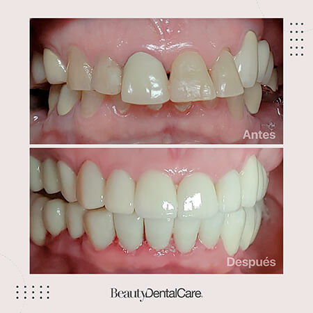 Blanqueamiento dental