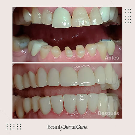 Implantes dentales