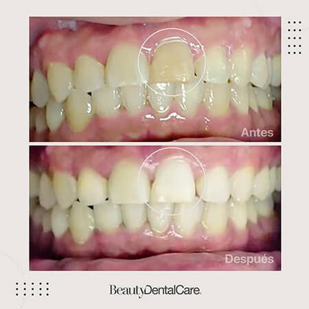 Blanqueamiento dental