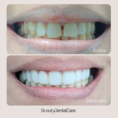 Diseño de sonrisa