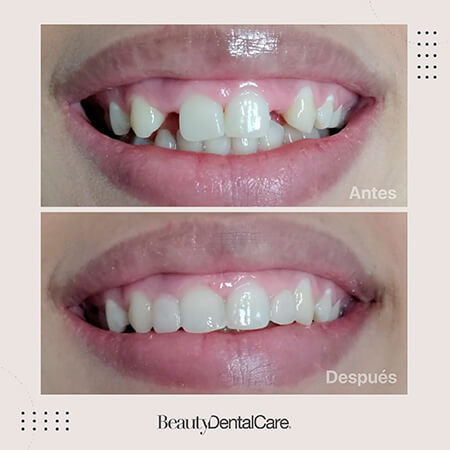 Diseño de sonrisa