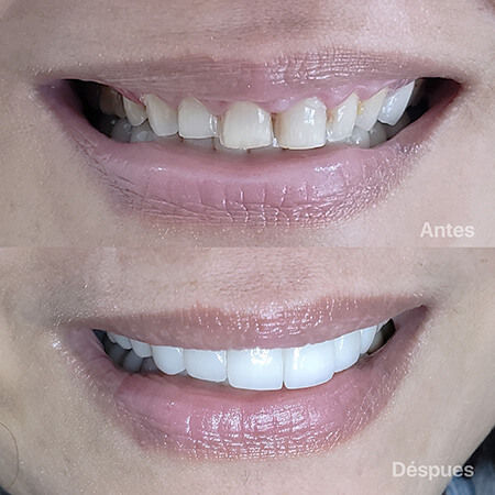 Diseño de sonrisa