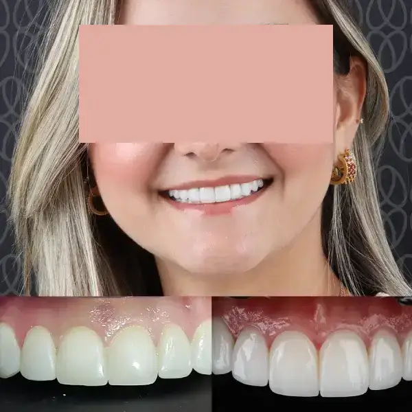 Diseño de sonrisa