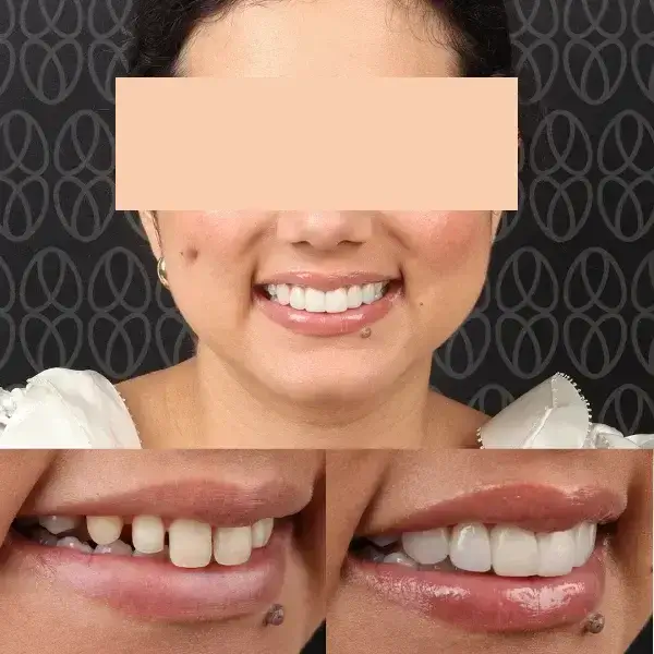 Carillas dentales