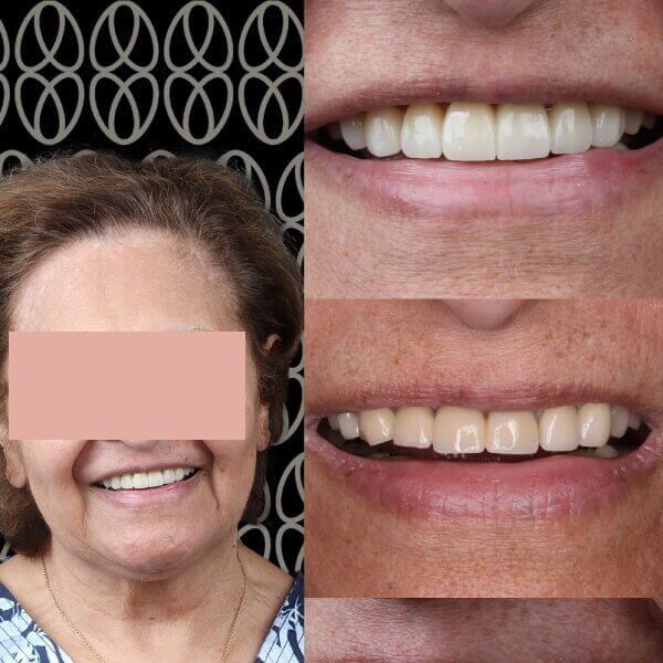 Carillas dentales