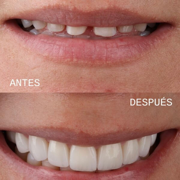 Diseño de sonrisa