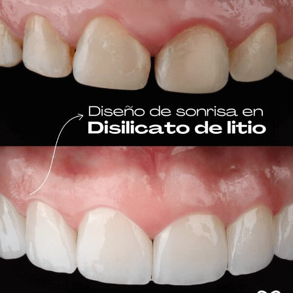 Carillas dentales