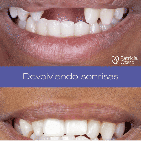Implantes dentales