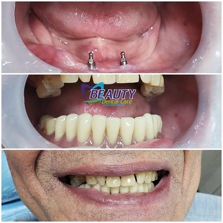 Implantes All on 4
