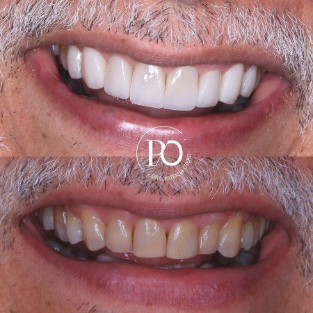 Diseño de sonrisa