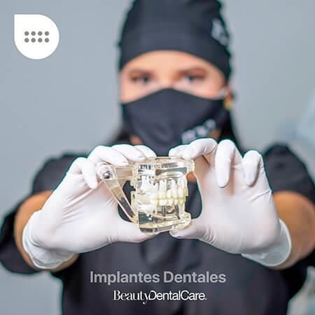 Implantes dentales