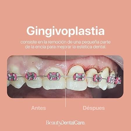 Gingivoplastia
