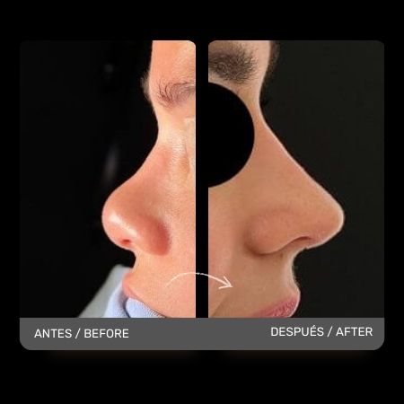 Nose Job