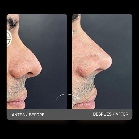 Masculine Nose Surgery