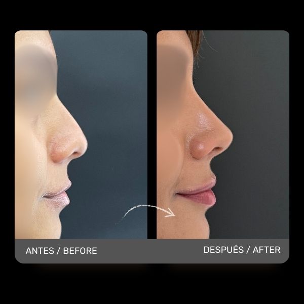 Nose Job