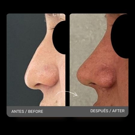 Masculine Nose Surgery
