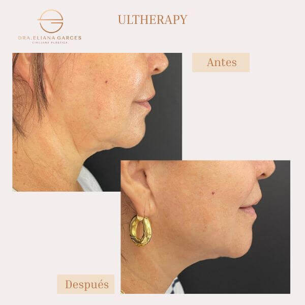Ultherapy