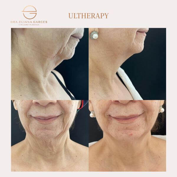 Ultherapy